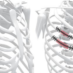 Neuro France Implants Thorib5