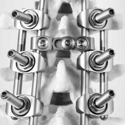 Scoliosis reduction