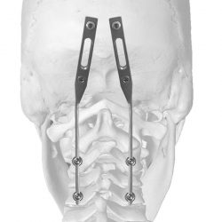 neuro-france-implants-joc-3