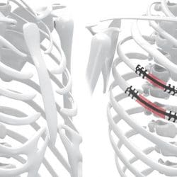 neuro-france-implants-thorib5